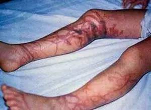 一海滩惊现毒水母,剧毒水母被蛰了