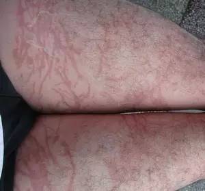 一海滩惊现毒水母,剧毒水母被蛰了