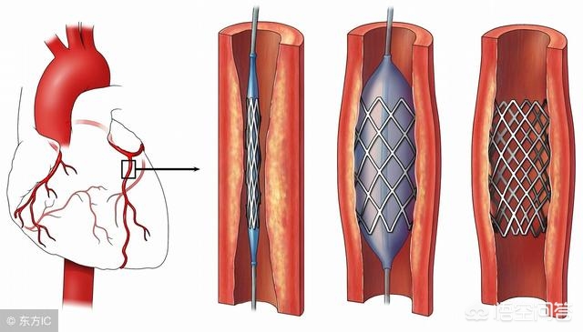 心脏溶栓和支架的区别是什么,心脏溶栓和支架的区别