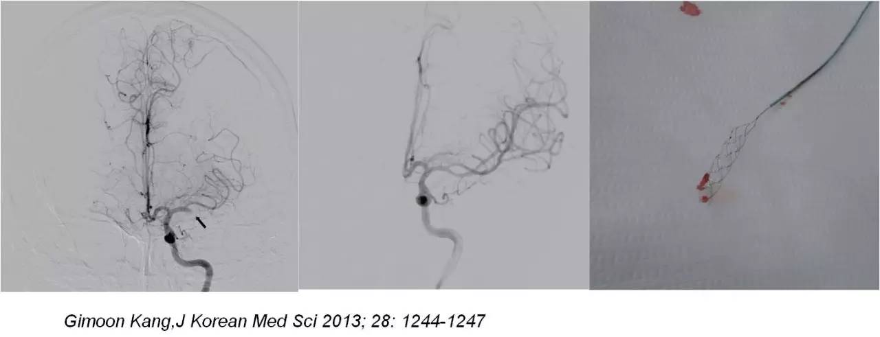 rt-pa溶栓的禁忌症,神经介入溶栓术联合静脉溶栓治疗