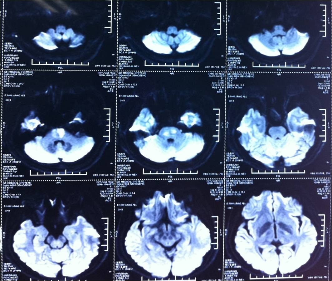 rt-pa溶栓的禁忌症,神经介入溶栓术联合静脉溶栓治疗