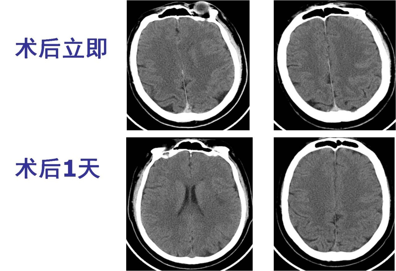 rt-pa溶栓的禁忌症,神经介入溶栓术联合静脉溶栓治疗