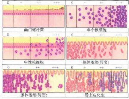 老年人慢性胃炎吃什么中成药,老年人慢性胃炎怎么治疗好得快