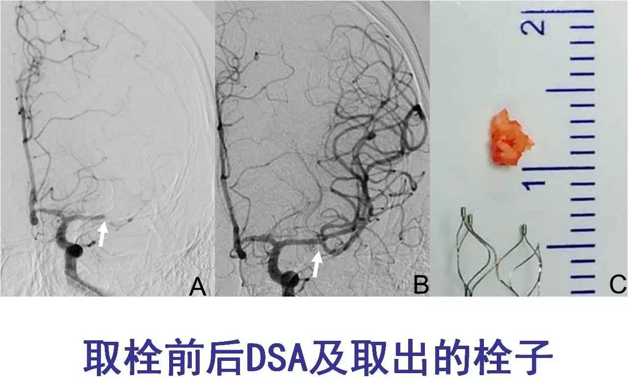 rt-pa溶栓的禁忌症,神经介入溶栓术联合静脉溶栓治疗