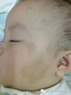 宝宝长雀斑样痣,宝宝长这种痣千万要关注