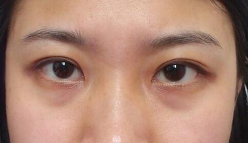 缓解黑眼圈的食品,睡觉能缓解黑眼圈