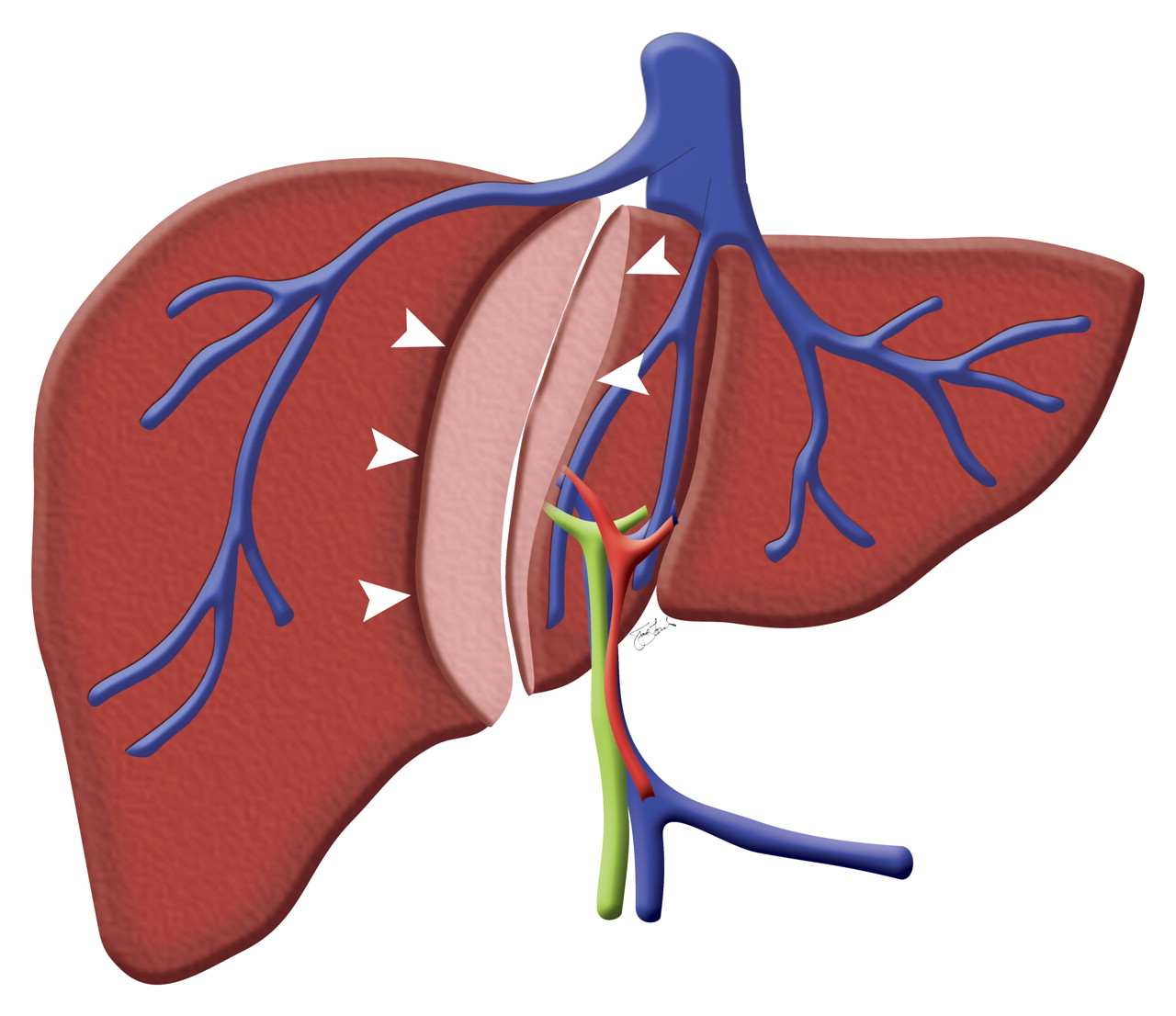 中医能治好乙肝病毒吗,乙肝病毒有克星吗