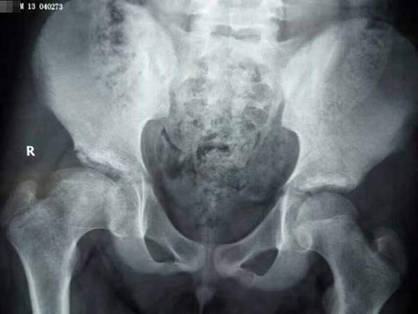 儿童股骨头坏死，“不治自愈”的传言不要再信了!