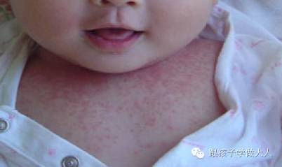 宝宝长雀斑样痣,宝宝长这种痣千万要关注