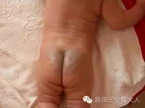 宝宝长雀斑样痣,宝宝长这种痣千万要关注