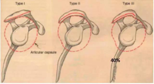 肩部撞击症,肩部撞击怎么康复