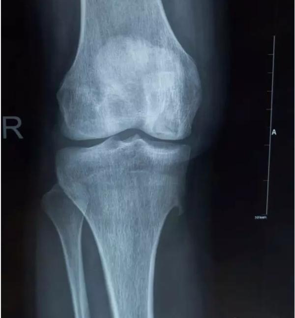 退行性骨关节炎的症状和治疗,退行性骨性关节炎分级