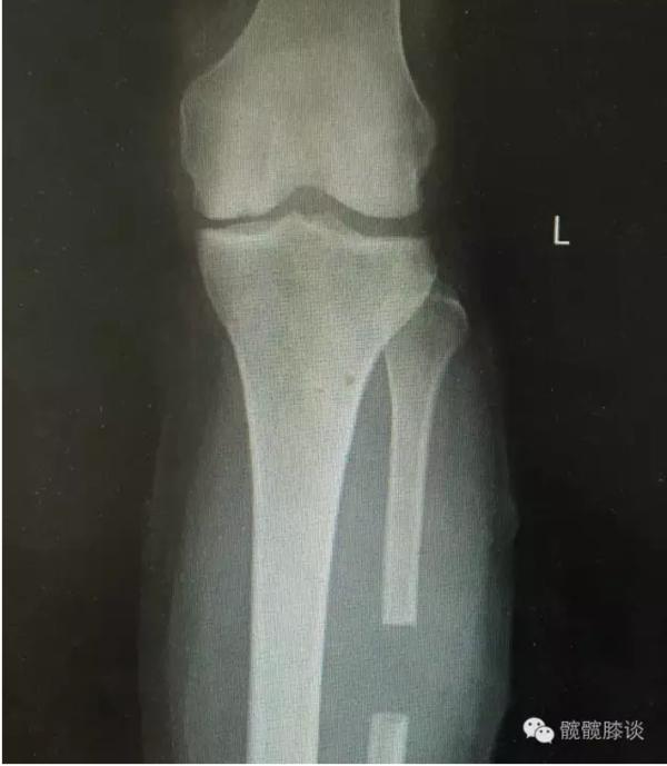 退行性骨关节炎的症状和治疗,退行性骨性关节炎分级