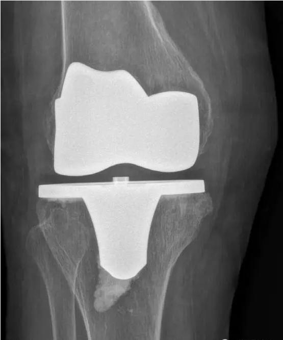 退行性骨关节炎的症状和治疗,退行性骨性关节炎分级