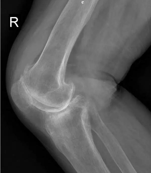 退行性骨关节炎的症状和治疗,退行性骨性关节炎分级