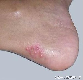 男性14岁趾间糜烂型脚气脱皮现象,脚上脱皮水泡痒脚趾缝溃烂