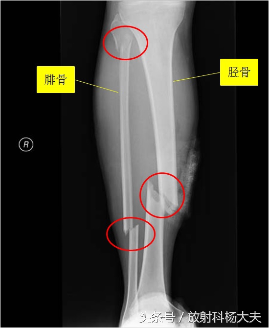 足球登巴巴受伤,足球登巴巴事件