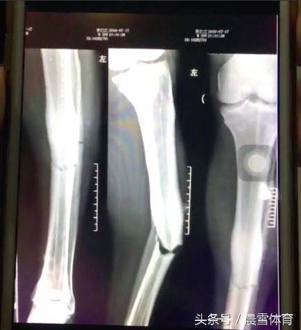 登巴巴断腿悲剧回放,登巴巴断腿事件外语解说