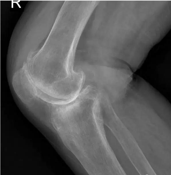 退行性骨关节炎的症状和治疗,退行性骨性关节炎分级