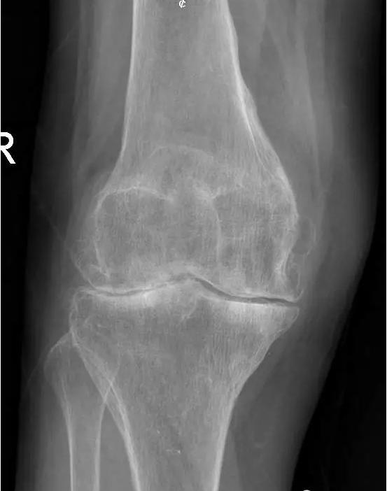 退行性骨关节炎的症状和治疗,退行性骨性关节炎分级