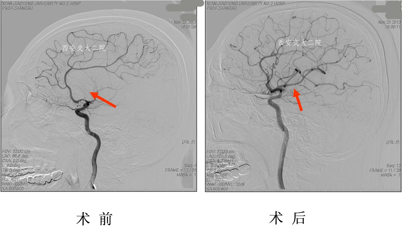 介入科病例,介入手术的健康科普方案
