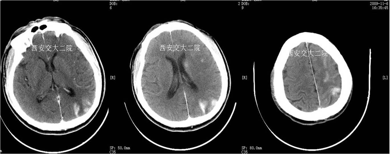 介入科病例,介入手术的健康科普方案