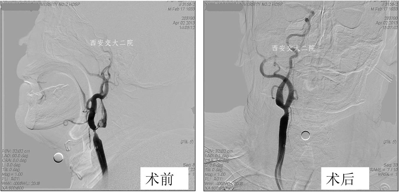 介入科病例,介入手术的健康科普方案