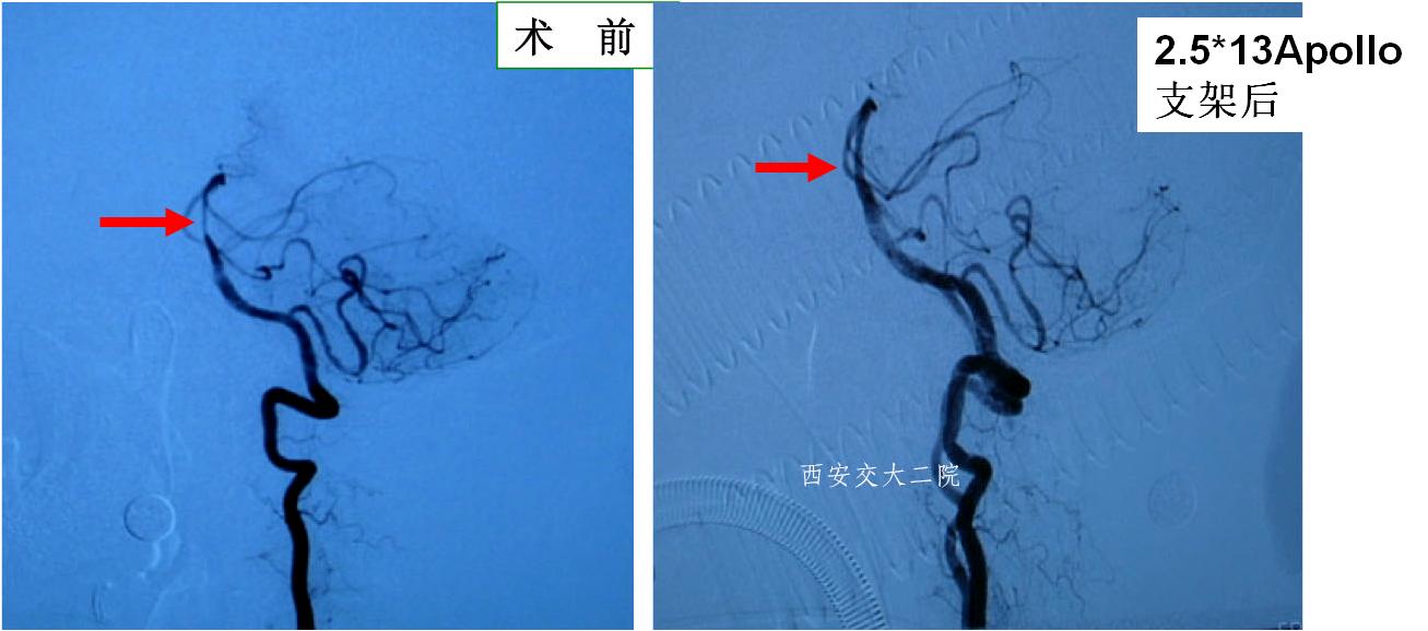 介入科病例,介入手术的健康科普方案