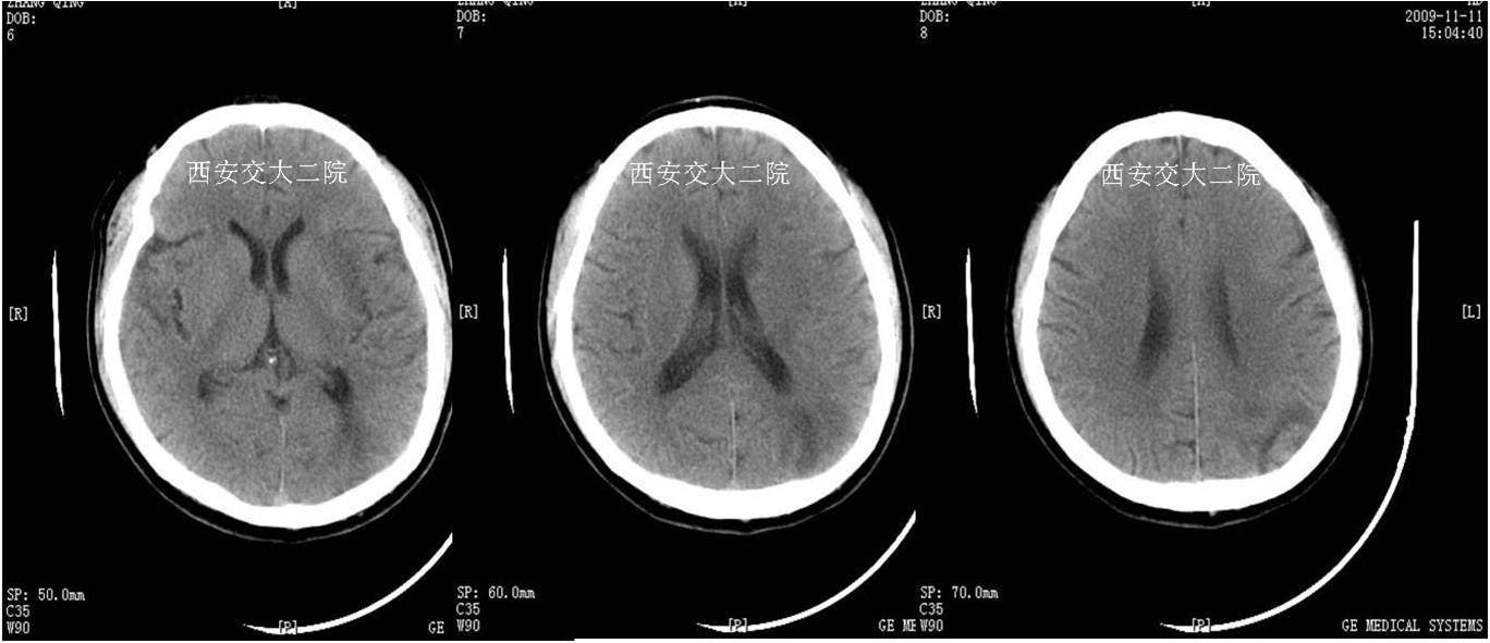介入科病例,介入手术的健康科普方案
