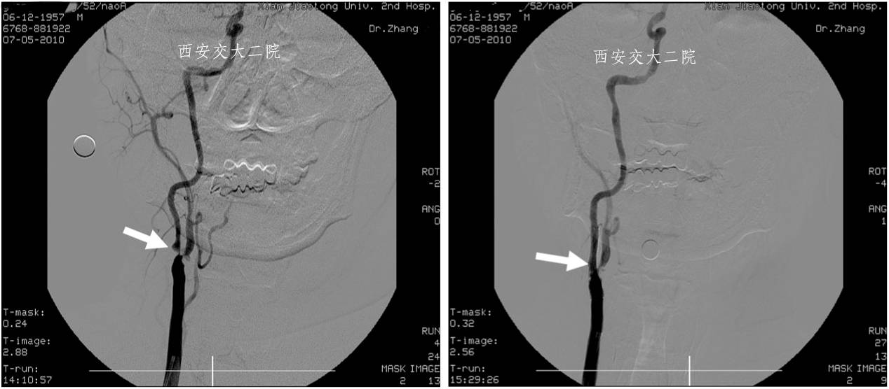 介入科病例,介入手术的健康科普方案