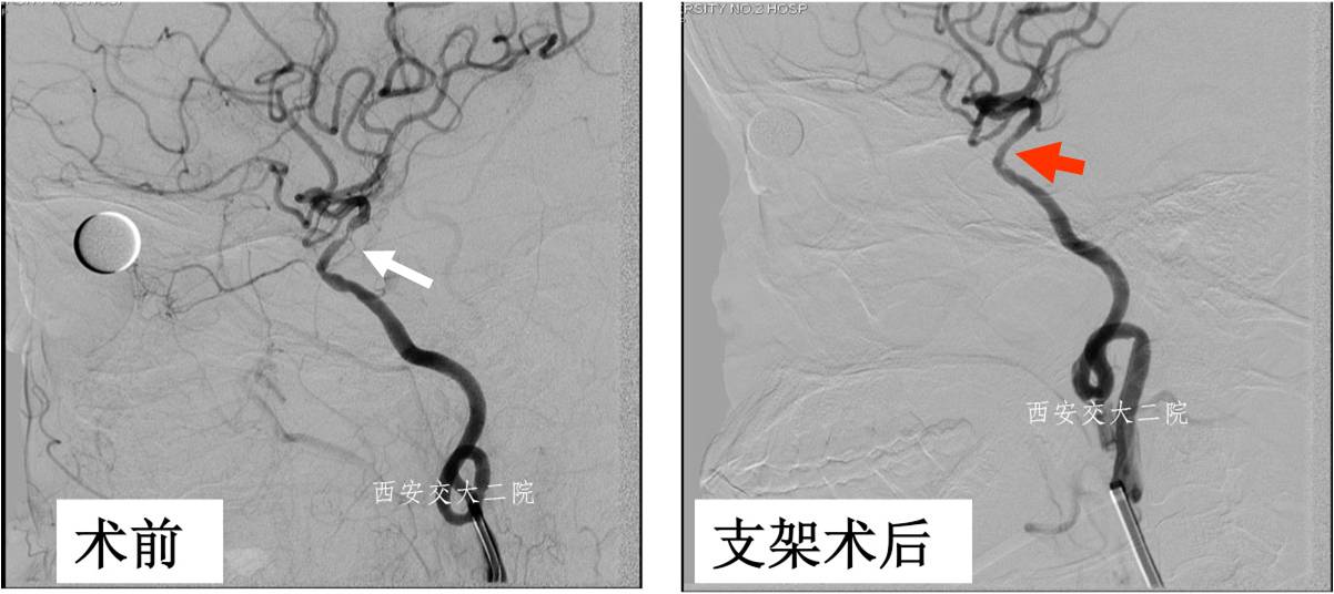 介入科病例,介入手术的健康科普方案