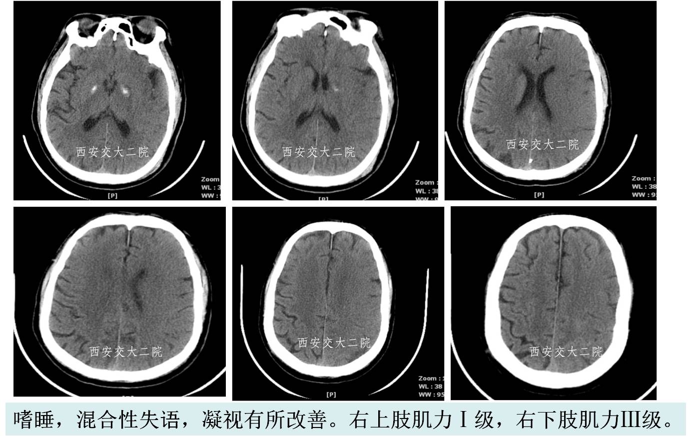 介入科病例,介入手术的健康科普方案