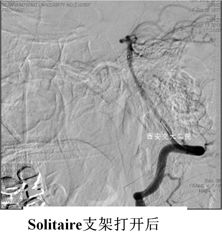 介入科病例,介入手术的健康科普方案