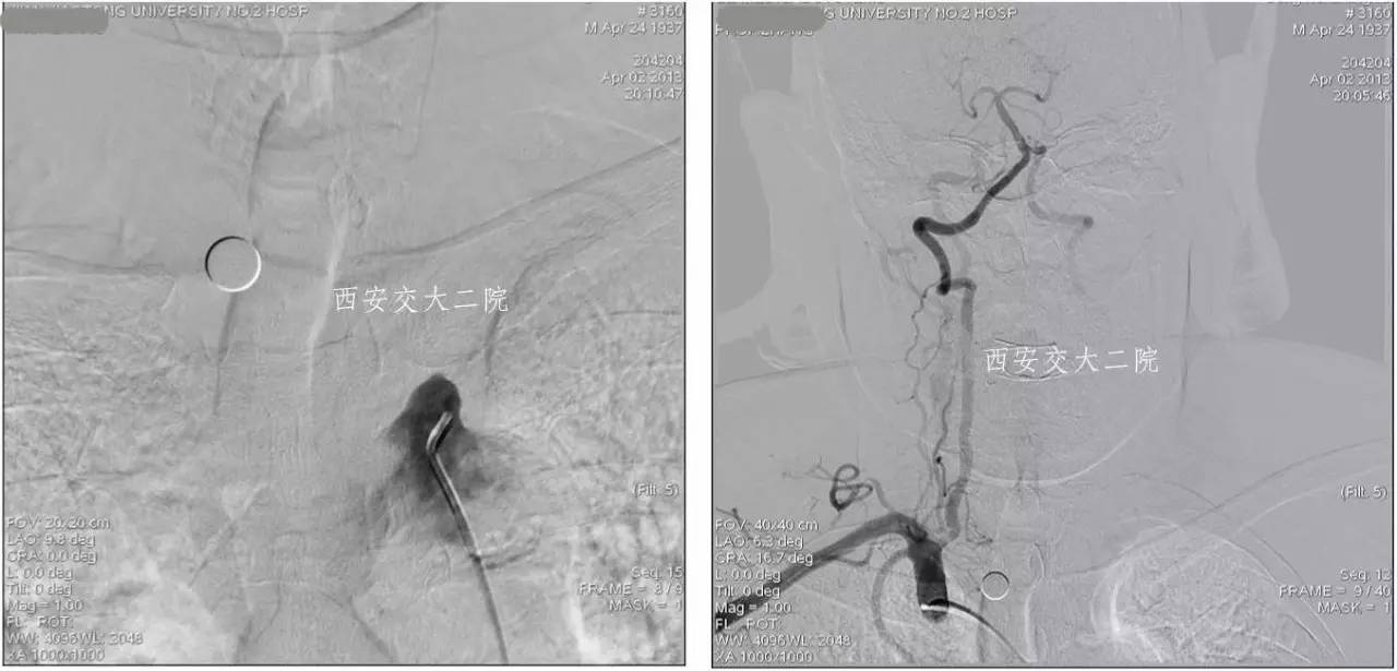 介入科病例,介入手术的健康科普方案
