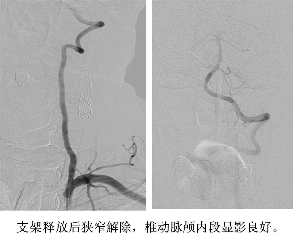 介入科病例,介入手术的健康科普方案