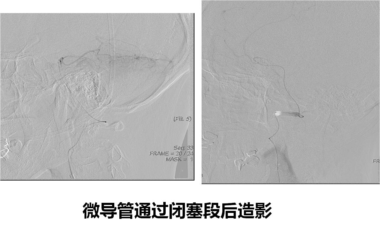 介入科病例,介入手术的健康科普方案
