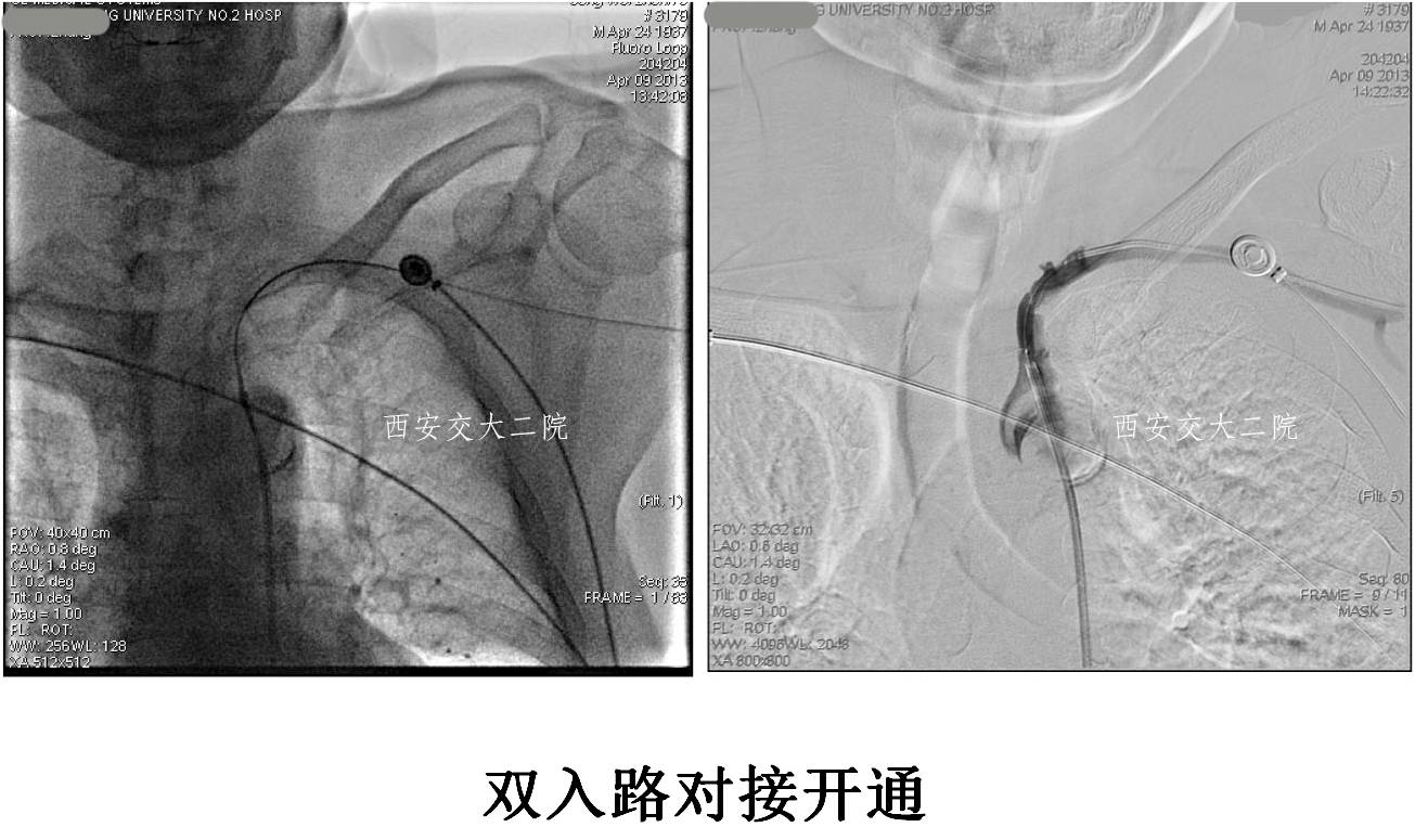 介入科病例,介入手术的健康科普方案