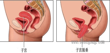 正常女性可以切除子宫吗,正常女性可以去切除子宫吗