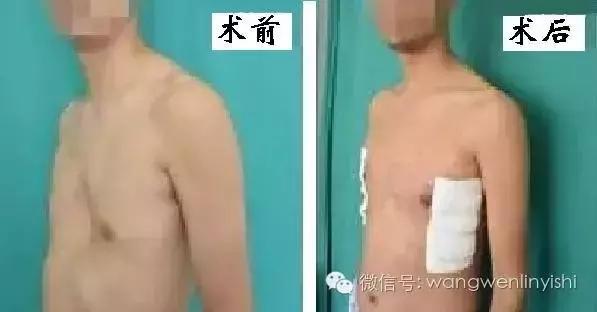 漏斗胸的治疗方法和关注事项,漏斗胸的正确解决方法