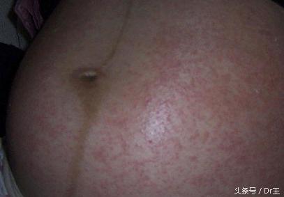 孕检临床诊断先兆流产怎么回事,流产胎儿基因检测