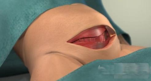 剖腹产的女人请好好珍惜,剖腹产女人要受多少罪