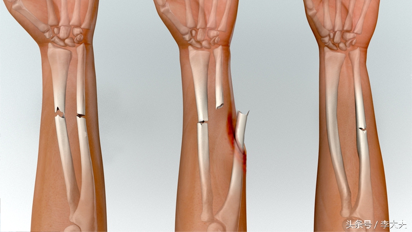 脑洞大开找出活下去的办法,断的骨头是怎样长回来的