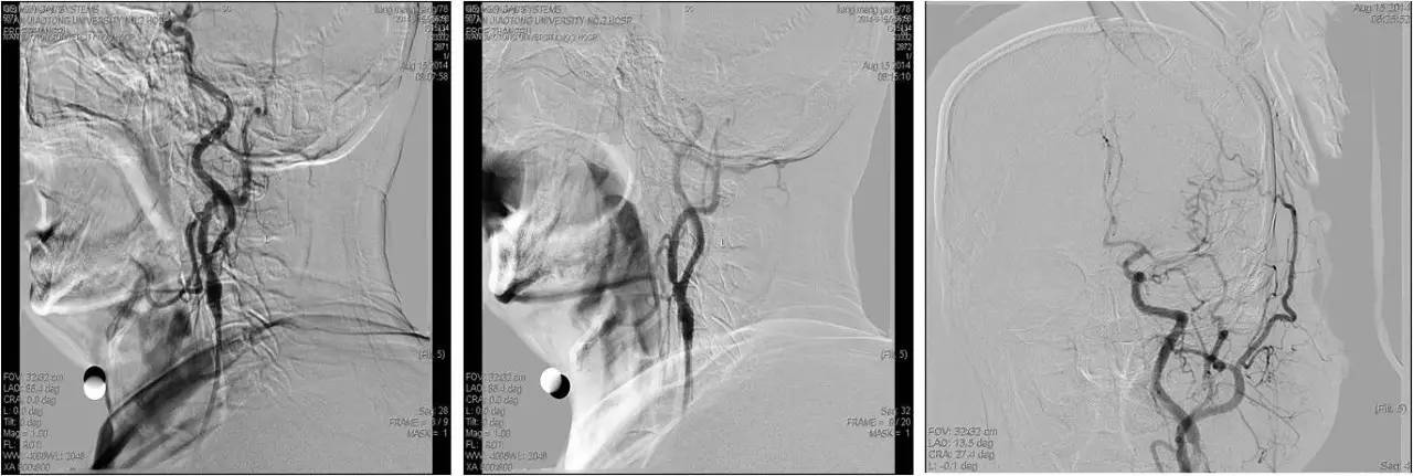 脑高灌注的处理措施,脑高灌注是什么意思