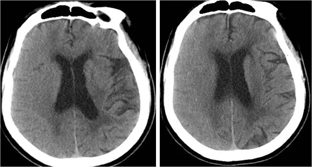 脑高灌注的处理措施,脑高灌注是什么意思
