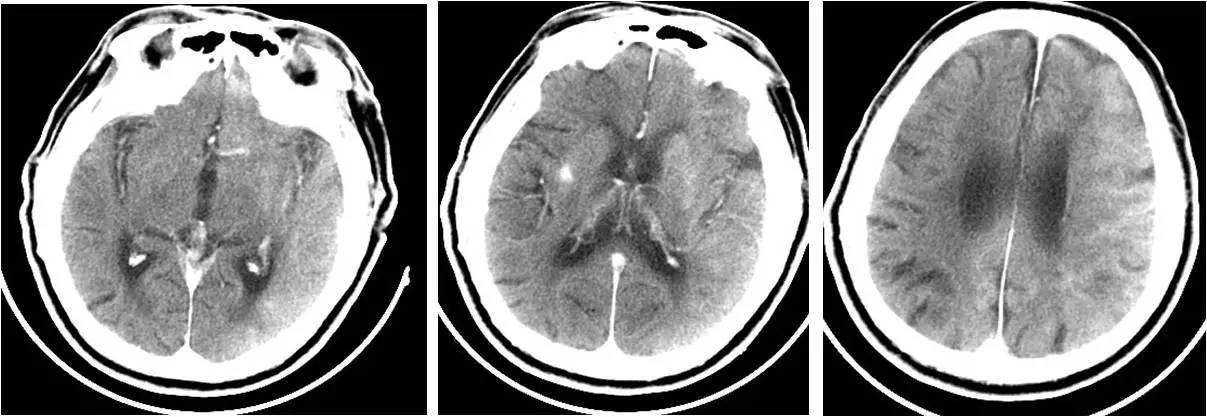 脑高灌注的处理措施,脑高灌注是什么意思