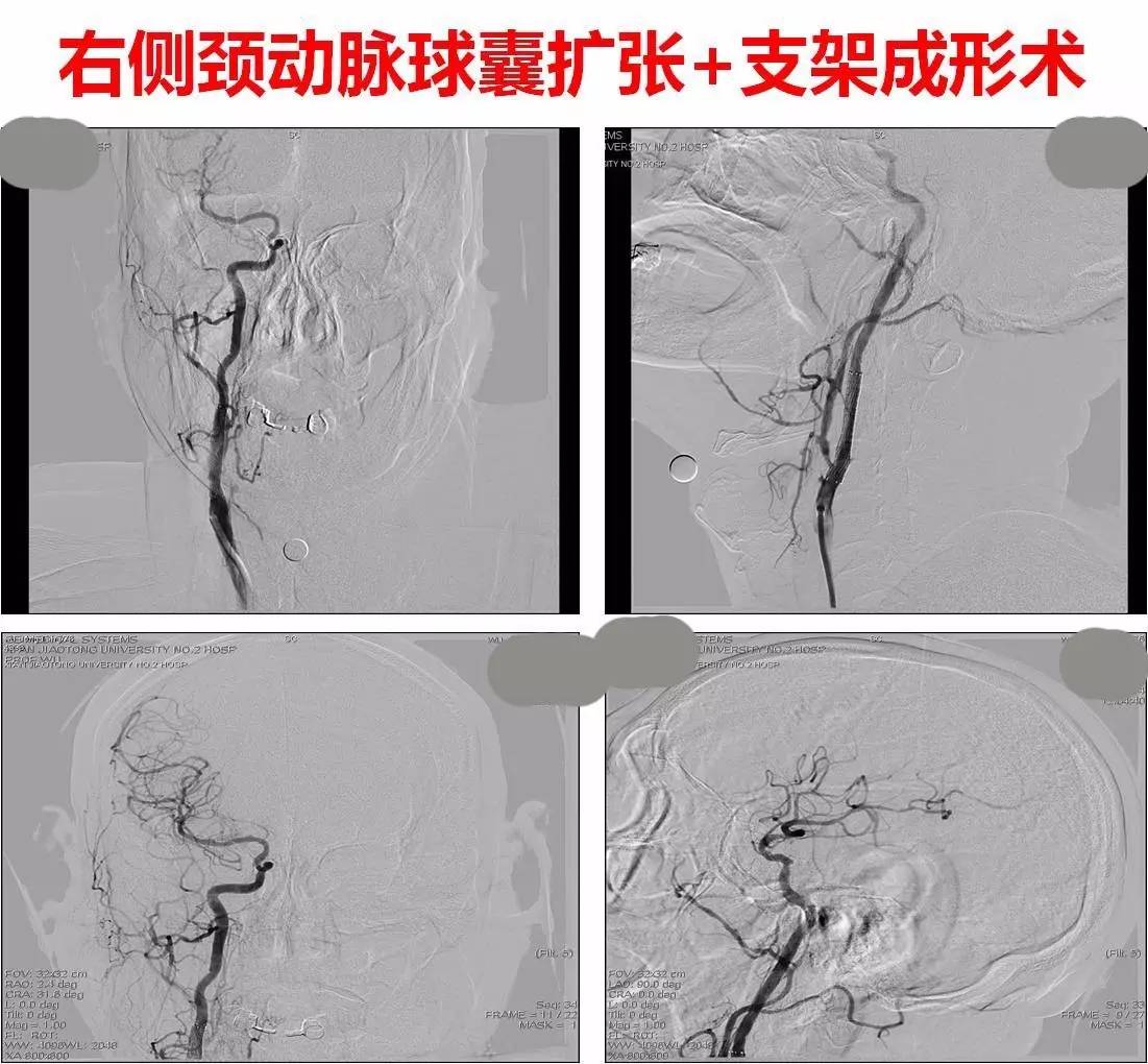 脑高灌注的处理措施,脑高灌注是什么意思