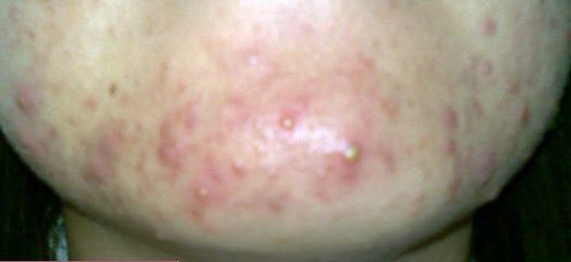 长水痘什么东西不能吃,长水痘能不能吃鸡蛋