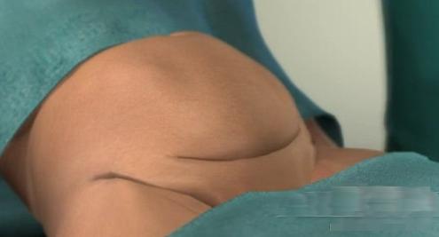 剖腹产的女人请好好珍惜,剖腹产女人要受多少罪