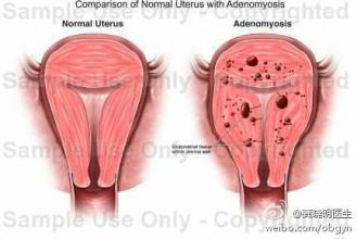 正常女性可以切除子宫吗,正常女性可以去切除子宫吗