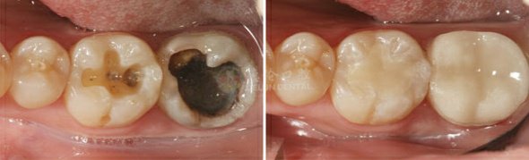 蛀牙的根管治疗,中医治疗蛀牙